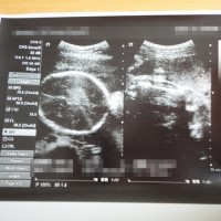 8か月検診（2回目）　エコー写真
